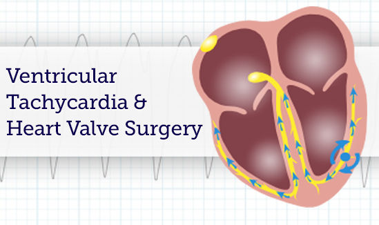 Ventricular Tachycardia and Heart Valve Surgery