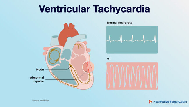Ventricular Tachycardia & Mitral Regurgitation