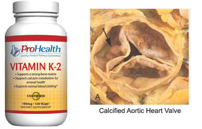 Vitamin K2 & Calcifed Heart Valve Stenosis