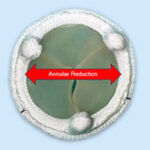 Y-Incision Annulus Expansion