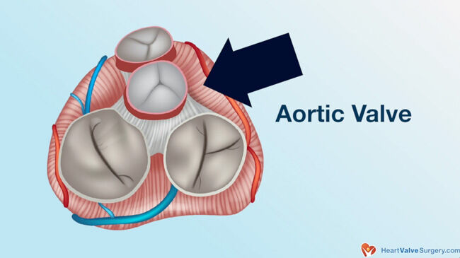 Aortic Valve Disease & Aneurysms