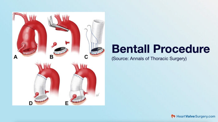 Bentall Procedure Diagram