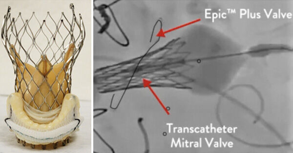 Epic Plus Valve-in-Valve Transcatheter Procedure (TMVR)