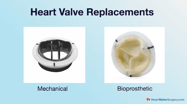 Types of Heart Valve Replacement Valves