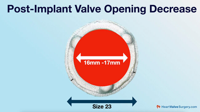 Post Implant Aortic Annulus Size Reduction