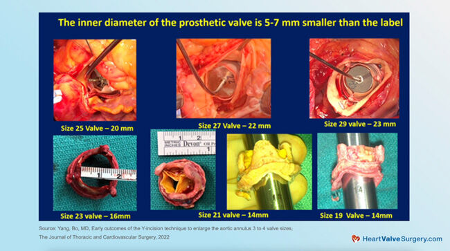 Prosthetic Heart Valve Replacement Smaller Than Label