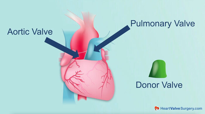 Ross Procedure Diagram