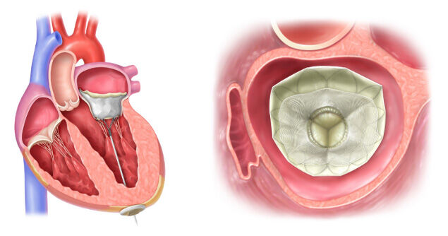 Implanted Tendyne TMVR