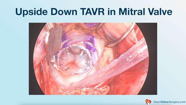 Upside Down TAVR in MItral Valve