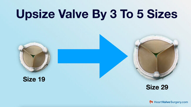 Upsize 23 to 29 Heart Valve Replacement Size