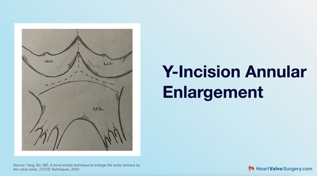 Y-Incision Annular Enlargement