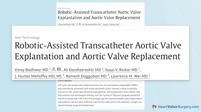 AATS Robotic Aortic Valve Replacement