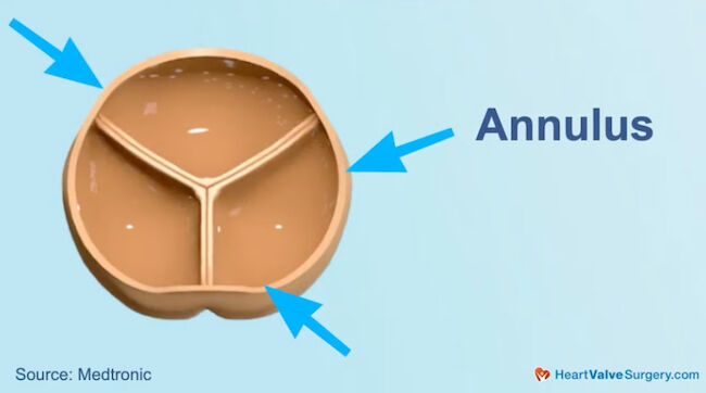 Drawing of Aortic Annulus