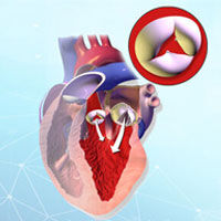 Aortic Valve Regurgitation