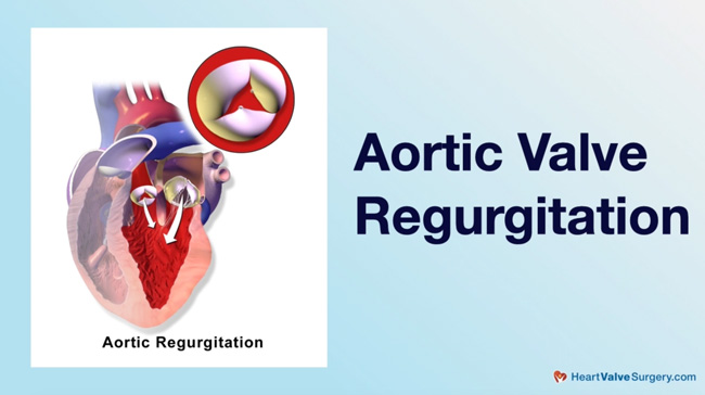 Aortic Valve Regurgitation