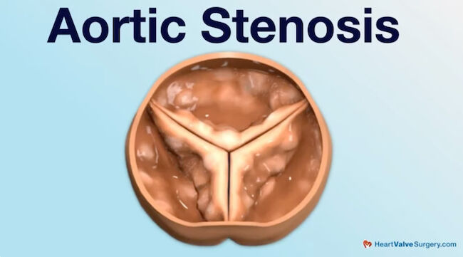 Aortic Stenosis Drawing