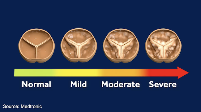 Aortic Stenosis Phases from Normal to Severe