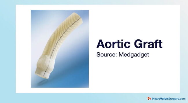 Aortic Graft Wrapped in Dacron