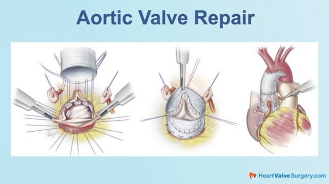 Aortic Valve Repair Drawing
