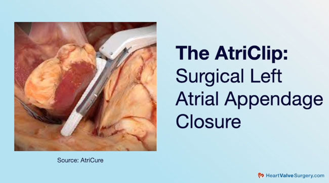 AtriClip - Left Surgical Appendage Closure