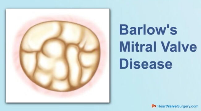 Barlow's Mitral Valve Disease Drawing