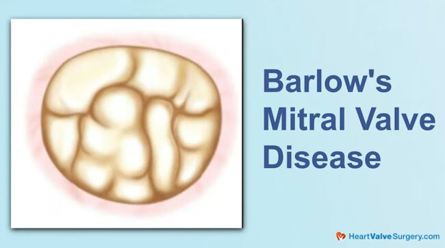 Barlow's Mitral Valve Disease Drawing