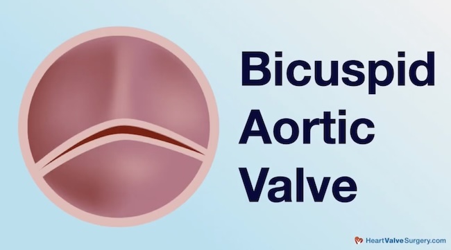 Bicuspid Aortic Valve Drawing