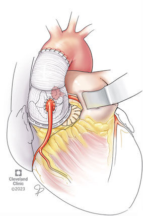 Bespoke Procedure 
