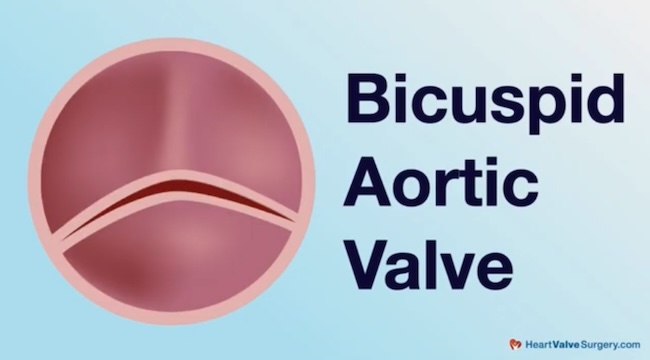 Bicuspid Aortic Valve Drawing