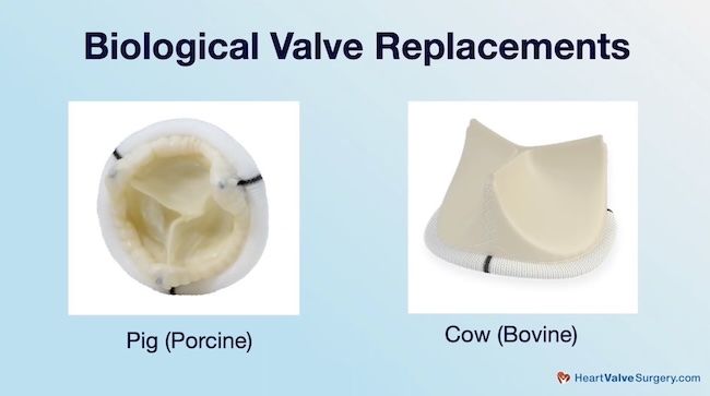 Biological Valve Replacements