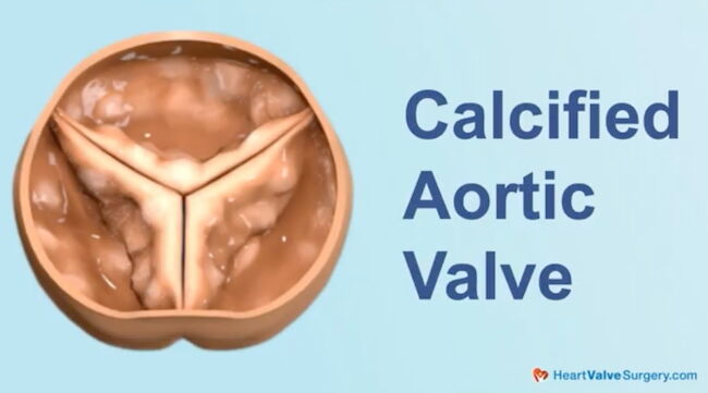 Calcified Aortic Valve