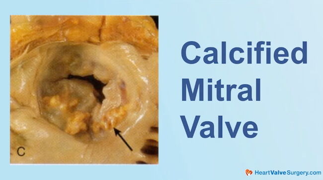 Calcified Mitral Valve