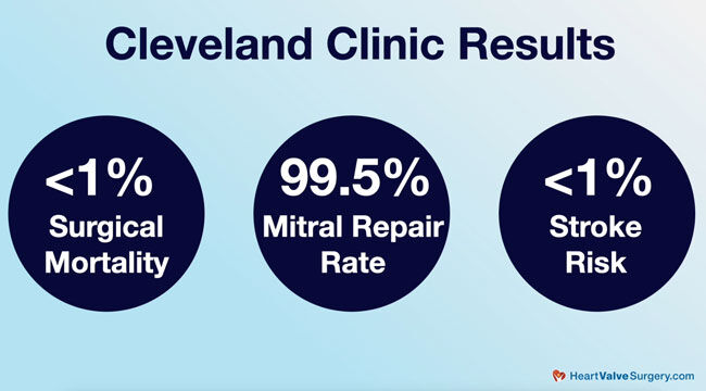 Cleveland Clinic Robotic Mitral Valve Repair Results & Outcomes