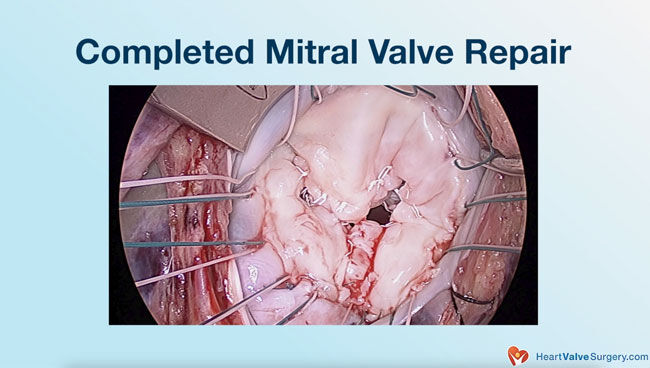 Completed Mitral Valve Repair in Operating Room