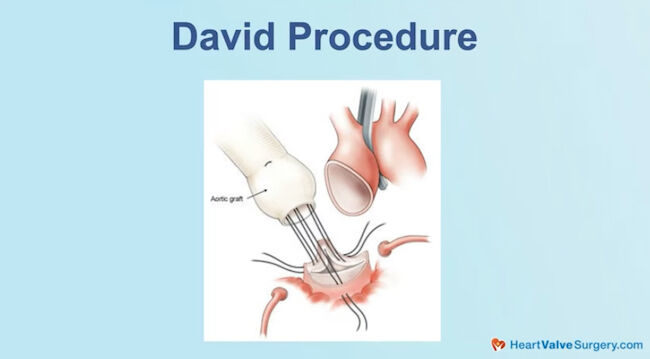 David Procedure Drawing
