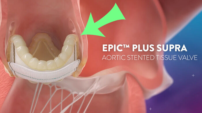 Epic Plus Supra Aortic Valve Replacement