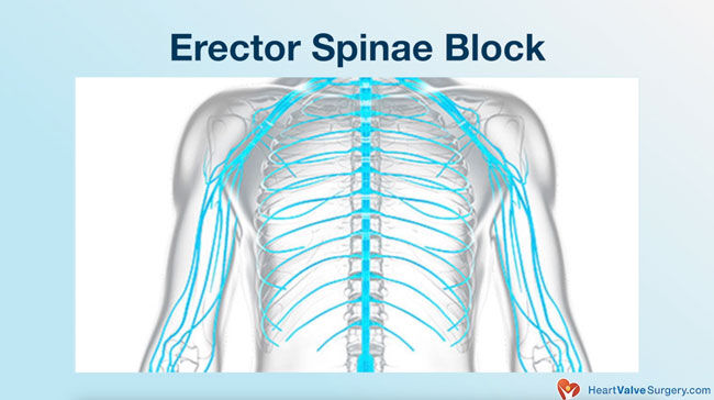 Erector Spinae Blog - Cryoanalgesia