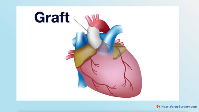 Graft Used During Aortic Aneurysm Surgery