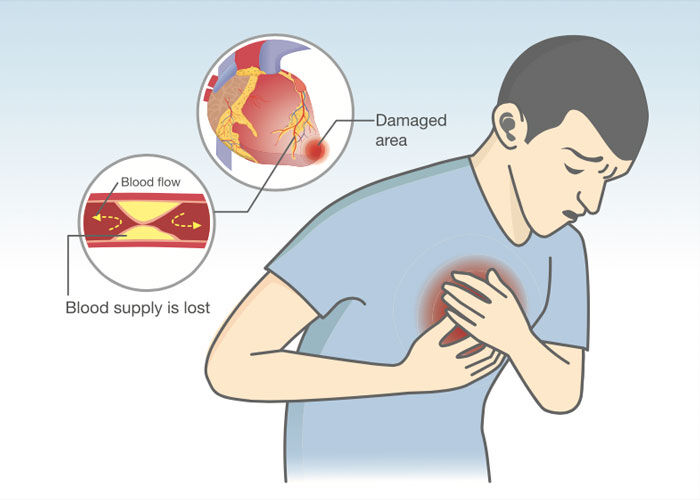 Coronary Artery Disease Heart Attack