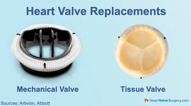 Heart Valve Replacement Options Mechanical & Tissue