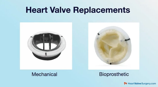 Valve Types for Heart Valve Replacement