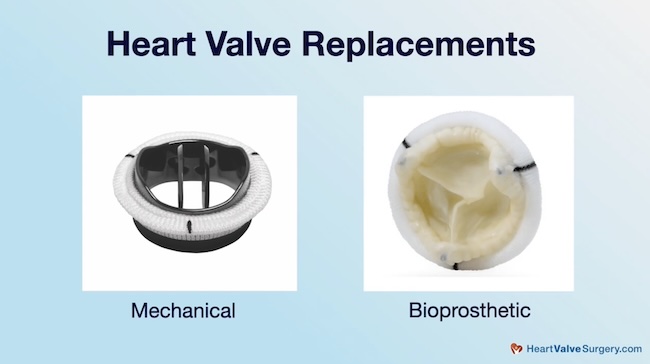 Heart Valve Replacements