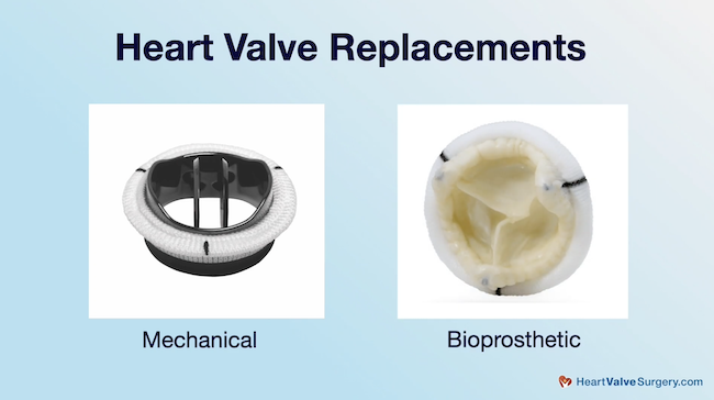 Heart Valve Replacements