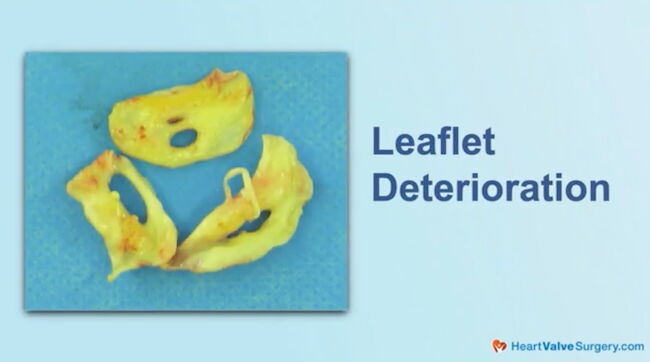 Aortic Leaflet Deterioration