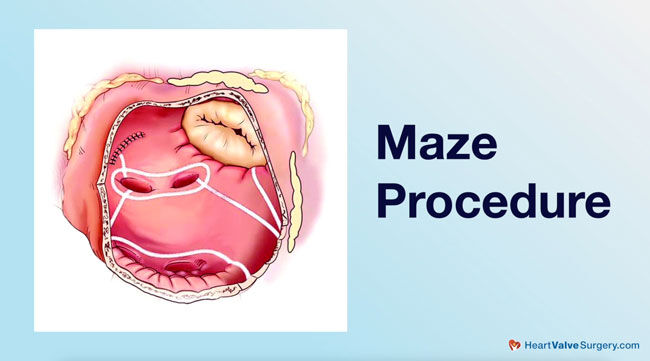 Maze Procedure