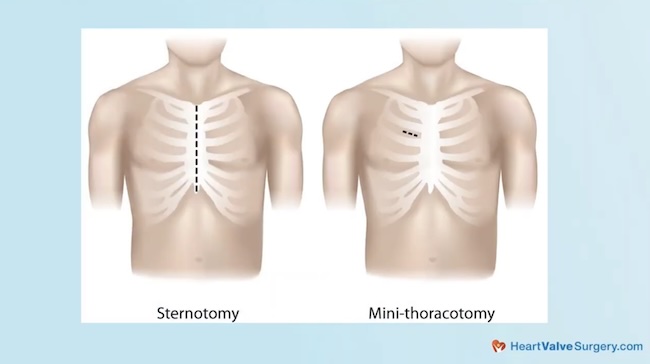 Minimally-invasive mini-thoracotomy
