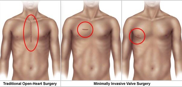 Minimally-Invasive Heart Valve Surgery