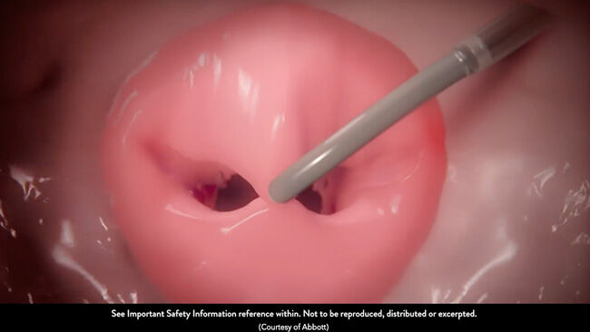 MitraClip Non-Anatomical Valve