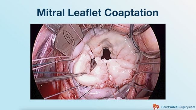 Mitral Leaflet Coaptation