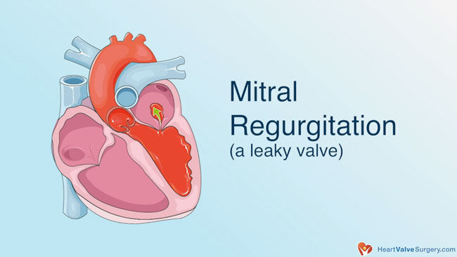 Mitral Regurgitation Leaking Heart Valve
